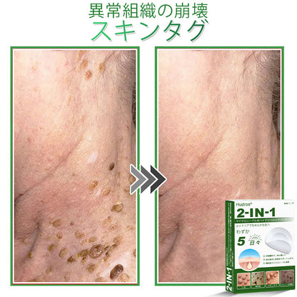 💆‍♀️本日限定80%OFF 🔥 Hudros® 2in1 マイクロニードル＆ハイドロコロイドパッチ｜ニキビ・肌荒れ・肌悩みを集中ケア｜目立ちにくい星型パッチ｜顔・ボディ用｜144枚入り