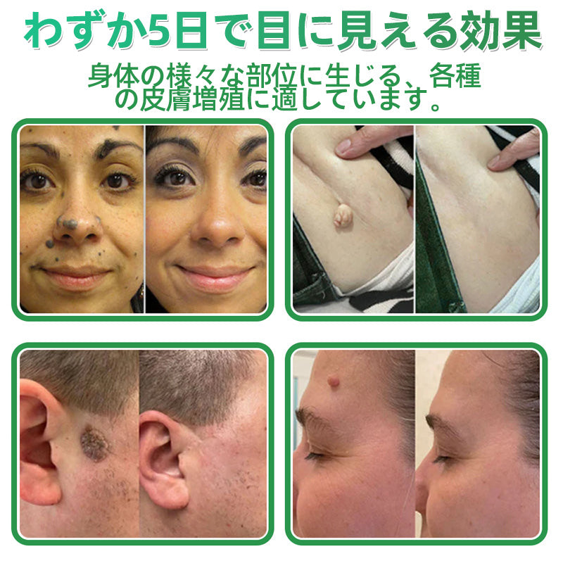 💆‍♀️本日限定80%OFF 🔥 Hudros® 2in1 マイクロニードル＆ハイドロコロイドパッチ｜ニキビ・肌荒れ・肌悩みを集中ケア｜目立ちにくい星型パッチ｜顔・ボディ用｜144枚入り