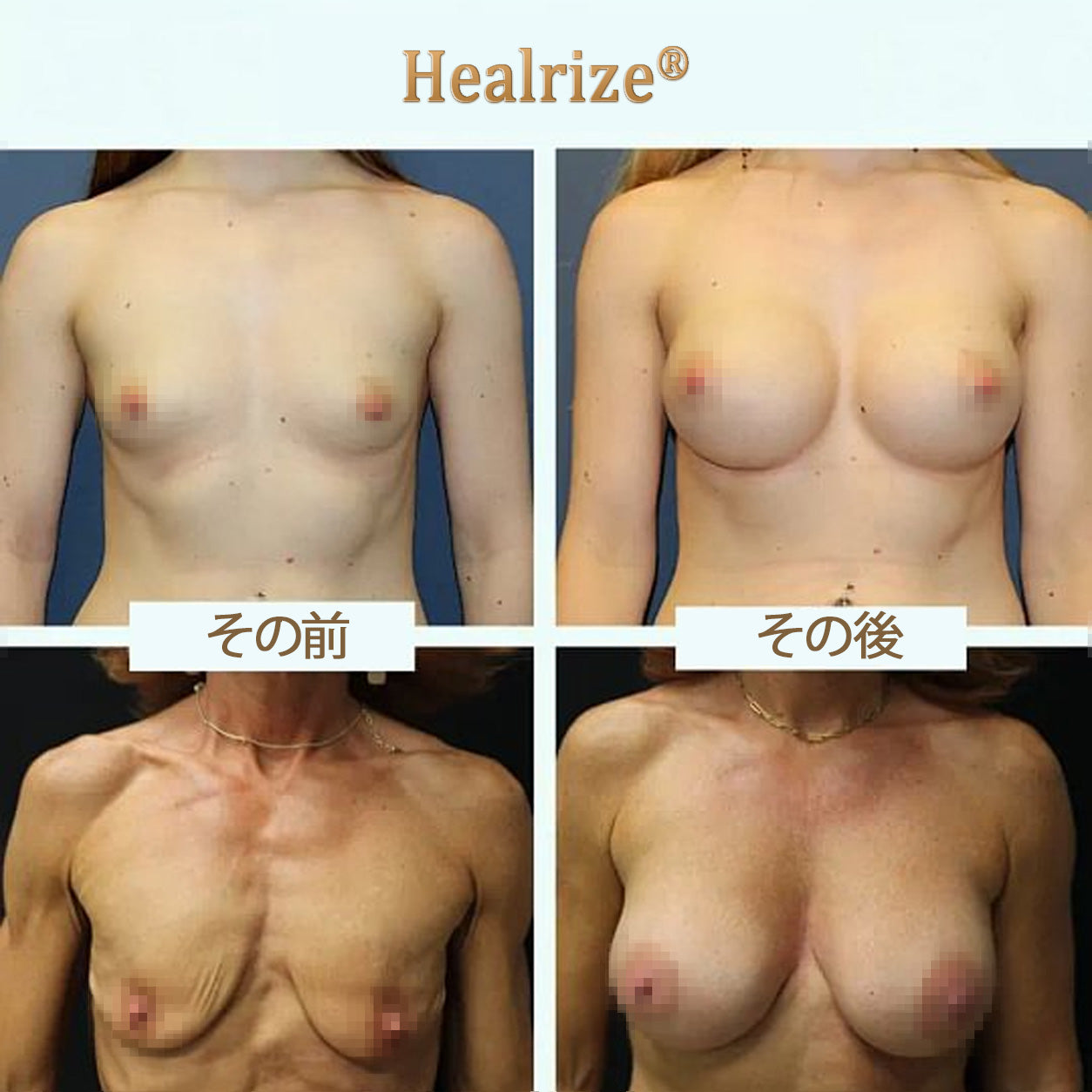 Healrize® ナノマイクロニードル バストリフトパッチ ✅｜手術不要・貼るだけでハリとふっくら感のある上向きバストラインをサポートし、女性らしい自信を取り戻すバストケアパッチ 🔥