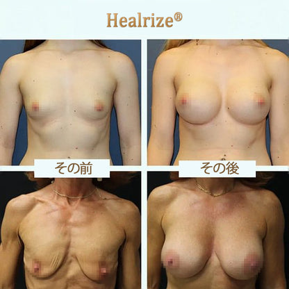 Healrize® ナノマイクロニードル バストリフトパッチ ✅｜手術不要・貼るだけでハリとふっくら感のある上向きバストラインをサポートし、女性らしい自信を取り戻すバストケアパッチ 🔥