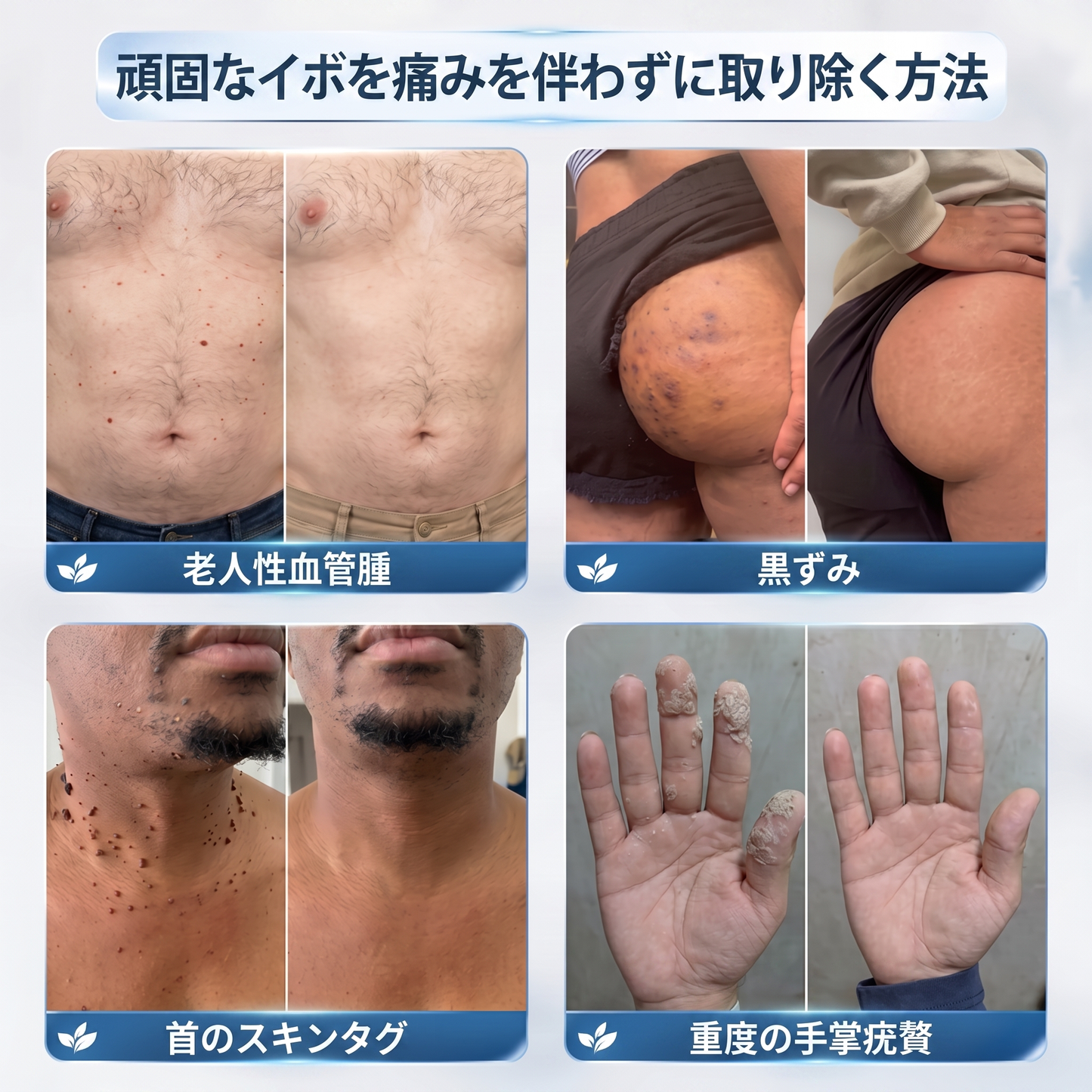 公式ブランドストア 🐉|🥇Trilumia® 7日間 タグ＆スポットイレーサー（無痛・跡残りゼロのローラーボール）
