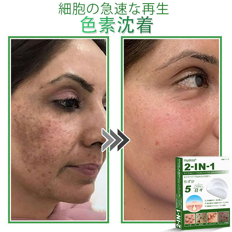 💆‍♀️本日限定80%OFF 🔥 Hudros® 2in1 マイクロニードル＆ハイドロコロイドパッチ｜ニキビ・肌荒れ・肌悩みを集中ケア｜目立ちにくい星型パッチ｜顔・ボディ用｜144枚入り