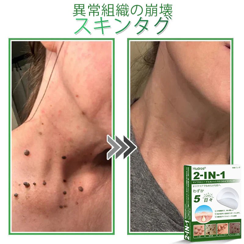 💆‍♀️本日限定80%OFF 🔥 Hudros® 2in1 マイクロニードル＆ハイドロコロイドパッチ｜ニキビ・肌荒れ・肌悩みを集中ケア｜目立ちにくい星型パッチ｜顔・ボディ用｜144枚入り