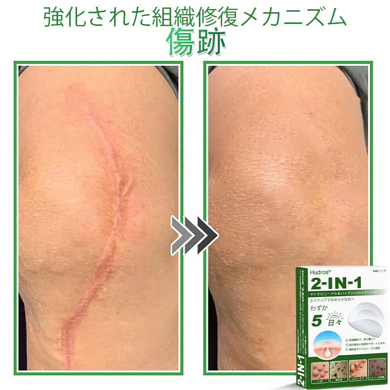 💆‍♀️本日限定80%OFF 🔥 Hudros® 2in1 マイクロニードル＆ハイドロコロイドパッチ｜ニキビ・肌荒れ・肌悩みを集中ケア｜目立ちにくい星型パッチ｜顔・ボディ用｜144枚入り