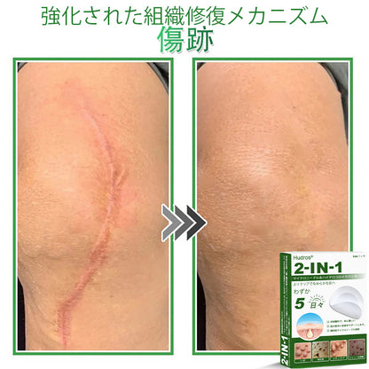 💆‍♀️本日限定80%OFF 🔥 Hudros® 2in1 マイクロニードル＆ハイドロコロイドパッチ｜ニキビ・肌荒れ・肌悩みを集中ケア｜目立ちにくい星型パッチ｜顔・ボディ用｜144枚入り