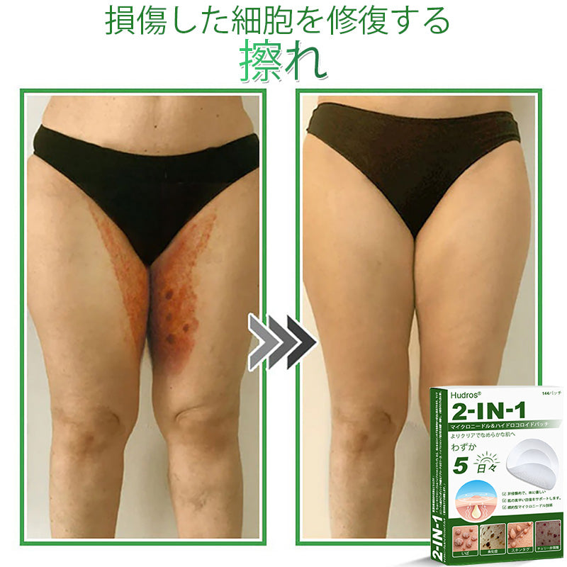 💆‍♀️本日限定80%OFF 🔥 Hudros® 2in1 マイクロニードル＆ハイドロコロイドパッチ｜ニキビ・肌荒れ・肌悩みを集中ケア｜目立ちにくい星型パッチ｜顔・ボディ用｜144枚入り