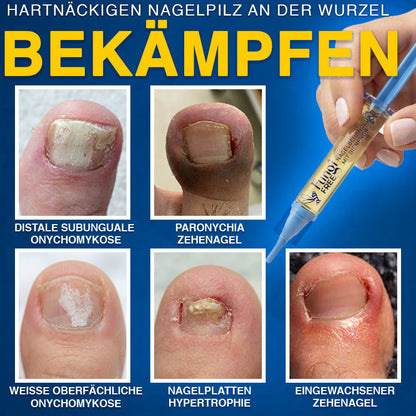 🇩🇪 CareBreeze® Fungi Free Bienengift-Nagelbehandlung 🥼