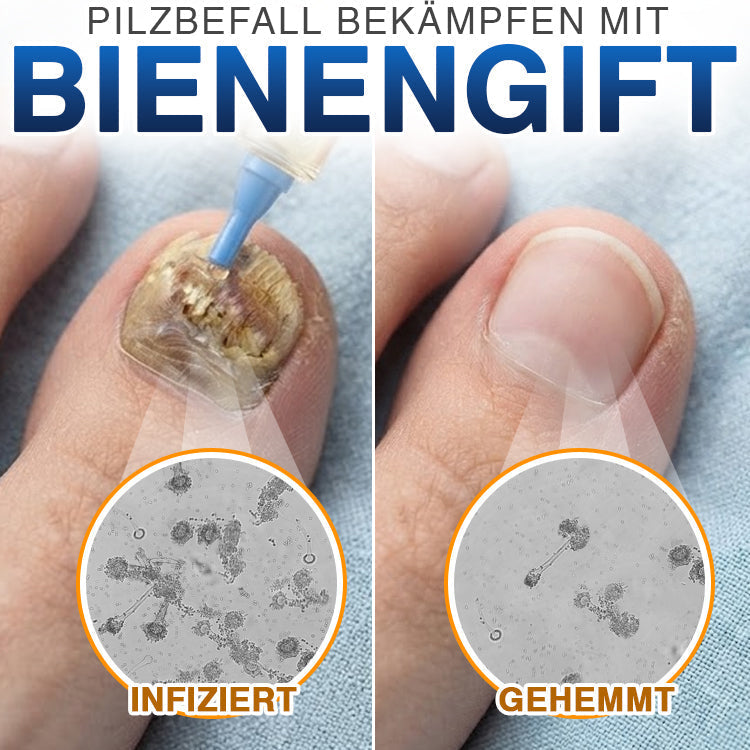 🇩🇪 CareBreeze® Fungi Free Bienengift-Nagelbehandlung 🥼