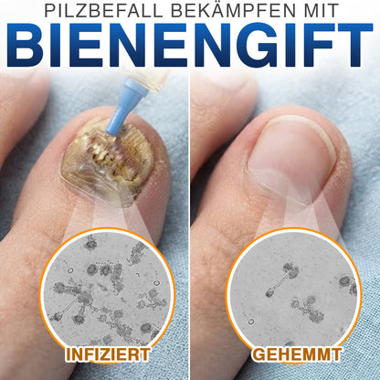 🇩🇪 CareBreeze® Fungi Free Bienengift-Nagelbehandlung 🥼
